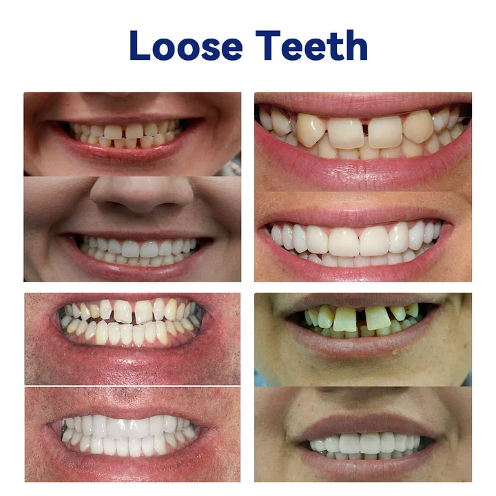 SmileFitPro – Ny Generation: Fleksibel Helprotese